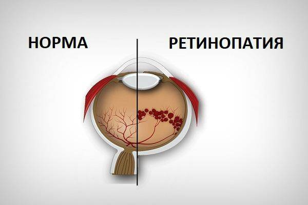 Что такое диабетическая непролиферативная ретинопатия сетчатки?