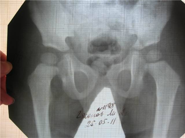 Рентгенография костей и суставов конечностей, рук и ног, в клинике цэлт, москва