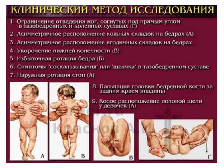 Дисплазия тазобедренных суставов у детей до года (новорожденных): лечение и признаки с фото