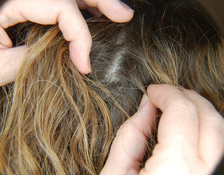 Чем и как вывести вшей и гнид у ребенка с длинными волосами: средства и методы лечения