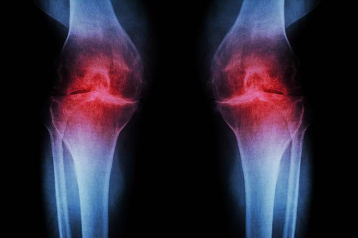 Как диагностировать артрит коленного сустава у детей