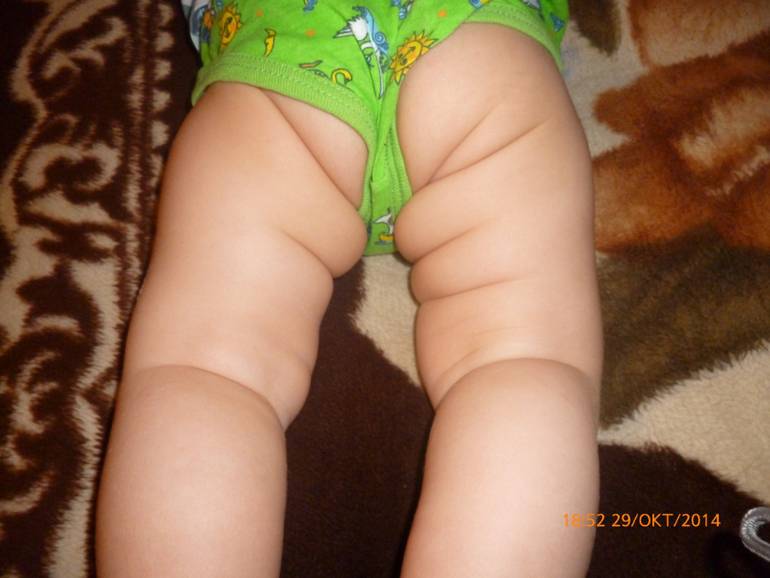 Несимметричные складки на ножках у грудничка, причины асимметрии у младенцев