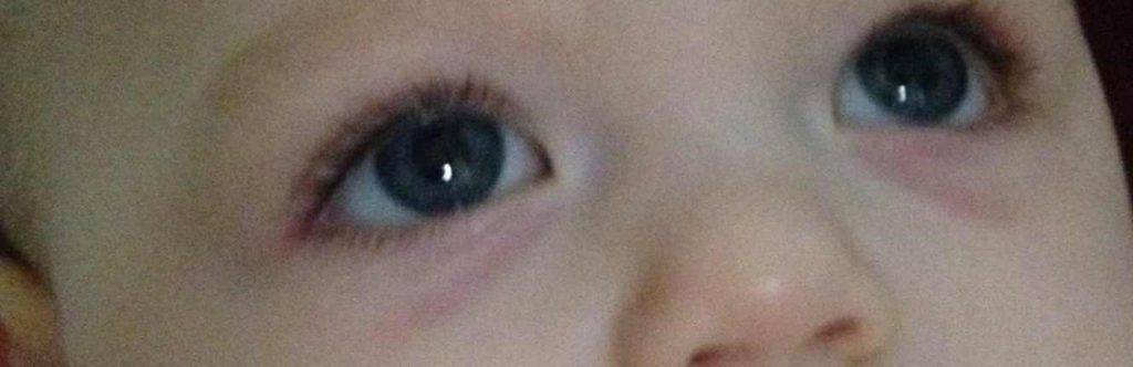Доктор комаровский о причинах синяков под глазами у ребенка: почему у ребенка темные круги