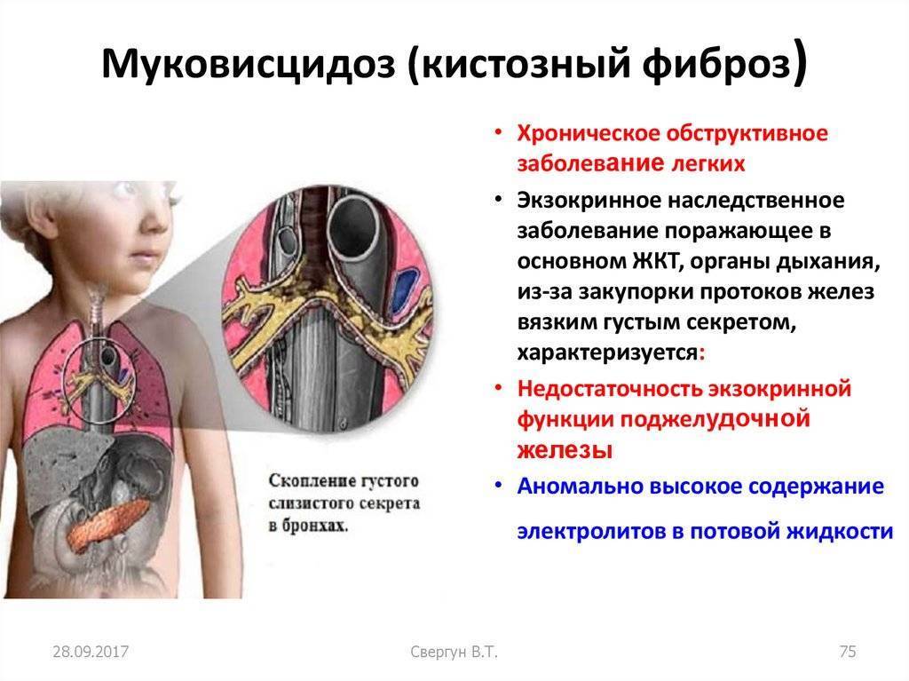Юлия кутимская — о борьбе за жизнь ребенка с муковисцидозом — медицинский портал «мед-инфо»