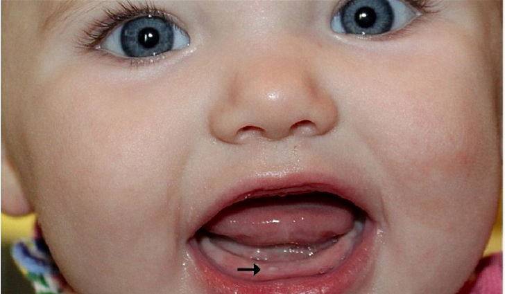 Сроки и порядок прорезывания молочных зубов у детей – схема, график
