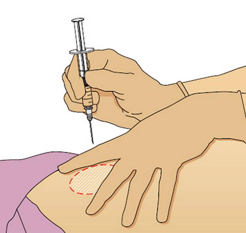 Как сделать ребенку укол правильно – техника внутримышечных уколов новорожденному