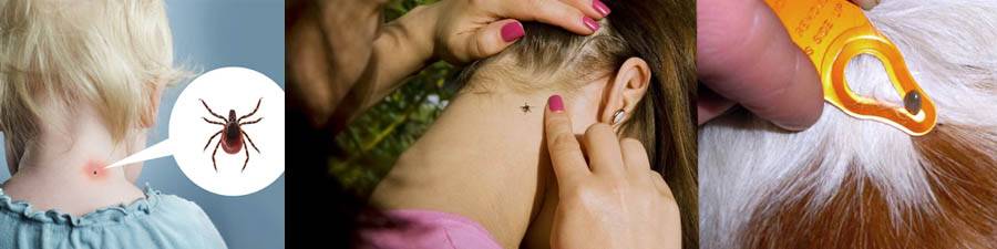 Ребенка укусил клещ: симптомы и последствия