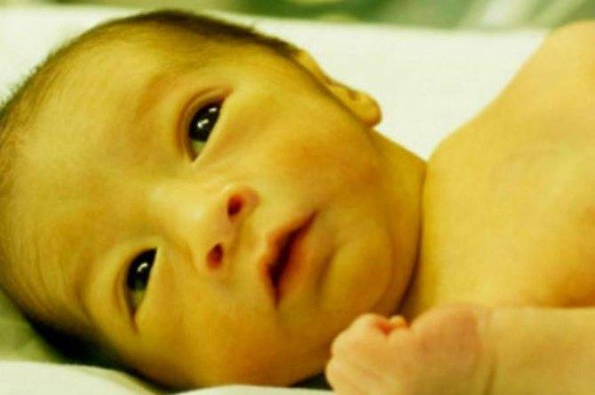 Появление желтухи у новорожденного ребенка