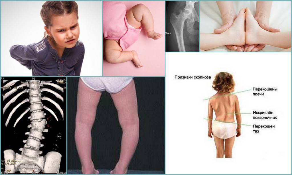 Заболевания тазобедренного сустава: виды и диагностика