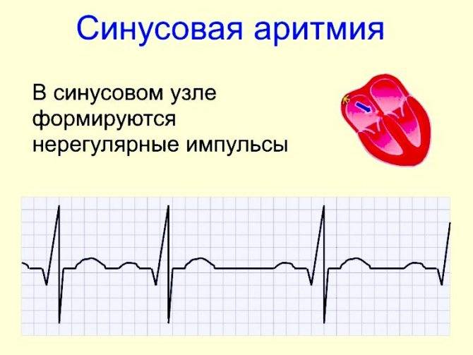 Аритмия - нарушения ритма сердца