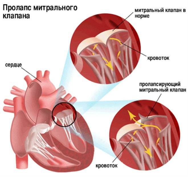 Пролабирование сердечных клапанов – норма или патология? Разбираемся с детским кардиологом