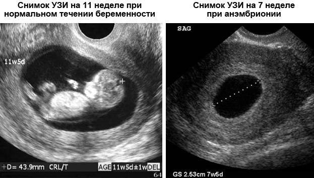 Второй малыш вслед за первым: беременность вскоре после родов