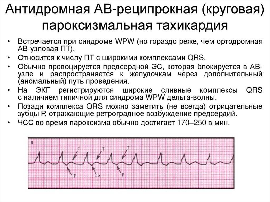 Синусовая аритмия у детей и подростков: причины нарушения ритма сердца, норма на ЭКГ, профилактика