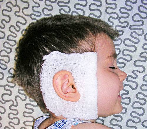 Согревающий компресс на ухо ребенку: алгоритм действий при отите и других заболеваниях