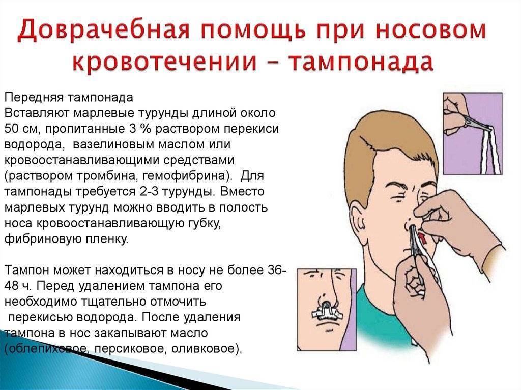 Кровь из носа: причины и какому врачу обратиться