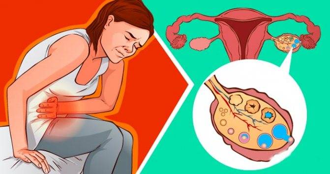Болят яичники перед месячными: в чем причина и может ли это означать беременность?
