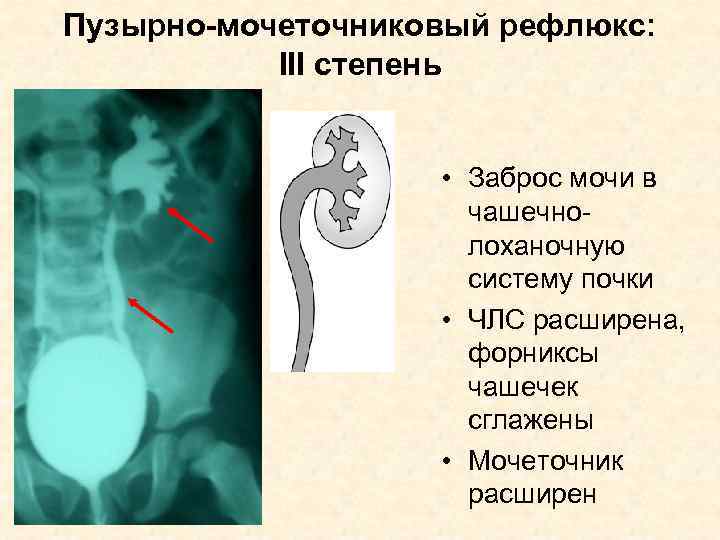 Рефлюкс у детей. Пузырно-мочеточниковый рефлюкс 3 степени. Почечно-мочеточниковый -рефлюкс симптомы. Лоханочно почечный рефлюкс рентген. Симптомы мочеточникового рефлюкса.