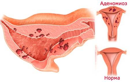 Аденомиоз что это. Эндометриоз матки (аденомиоз – внутренний эндометриоз).