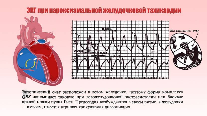 Синусовая тахикардия сердца: лечение у ребенка и причины