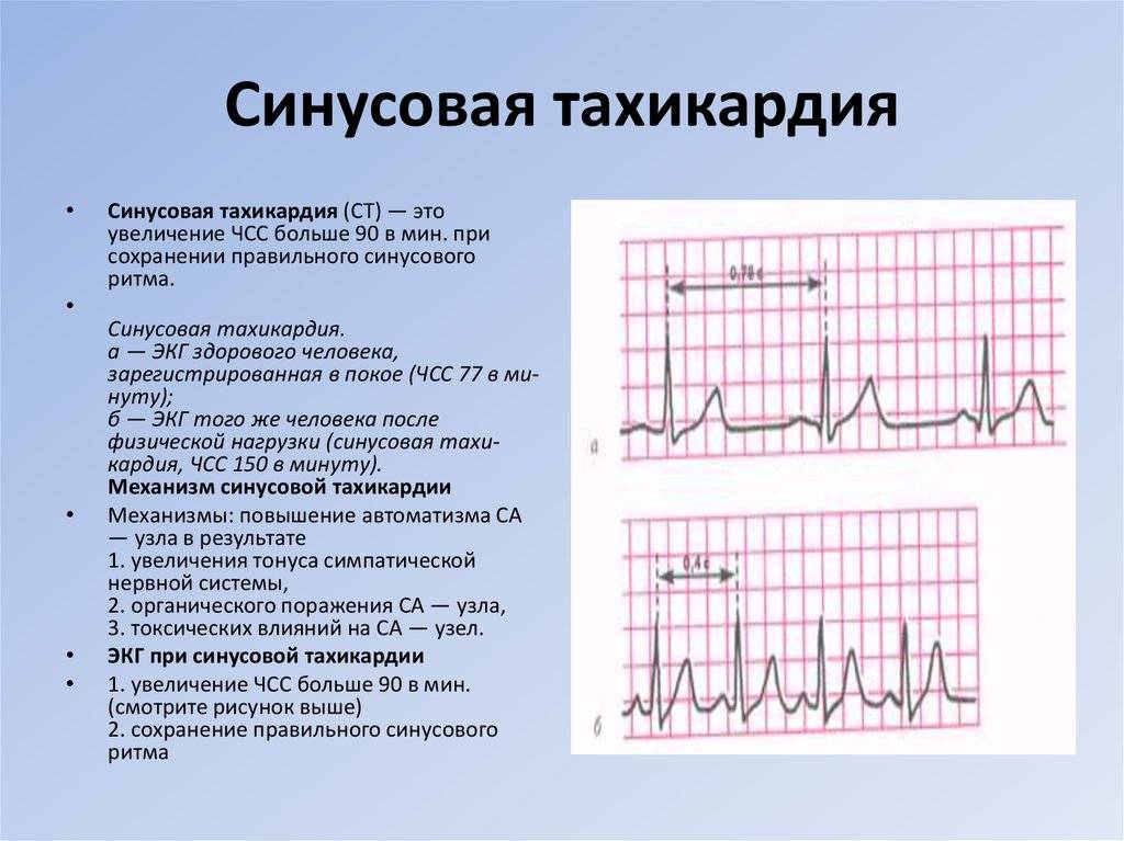 Нарушения сердечного ритма | кардиологический центр в санкт-петербурге