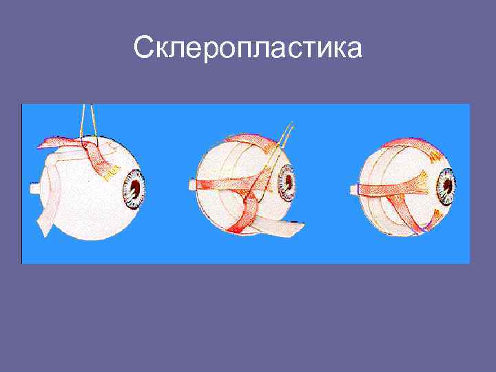 Склеропластика глаз у детей - что это такое, за и против, отзывы и цены на операцию - moscoweyes.ru - сайт офтальмологического центра "мгк-диагностик"