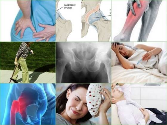 Артроз тазобедренного сустава — симптомы и лечение