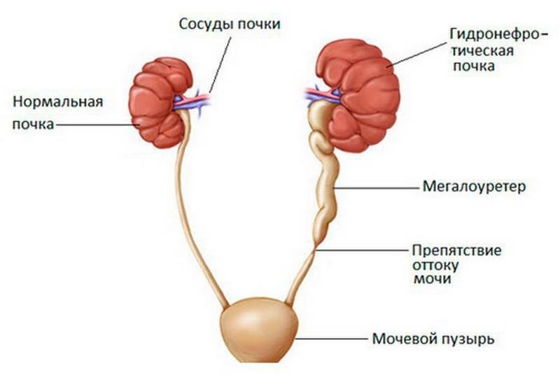 Консервативная урология детская (терапевтическое лечение почек и мочевого пузыря у детей)