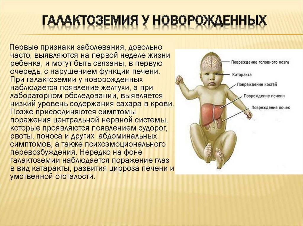 Симптомы галактоземии у новорожденных и норма фермента в крови у детей
