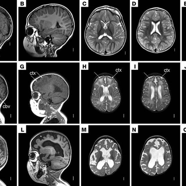 МРТ головного мозга ребенку и КТ-диагностика: что показывают, с какого возраста разрешены процедуры?