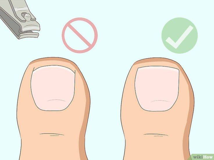 Псориаз ногтей: как привести ногти в порядок?