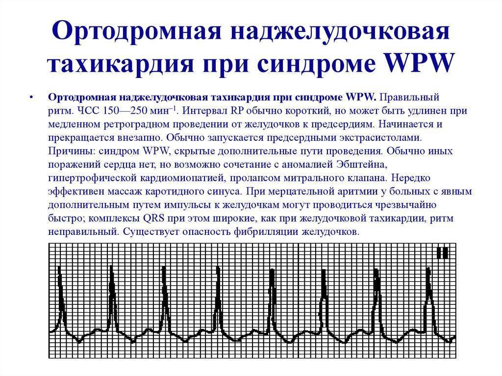 Учащенное сердцебиение (тахикардия). информация для пациентов