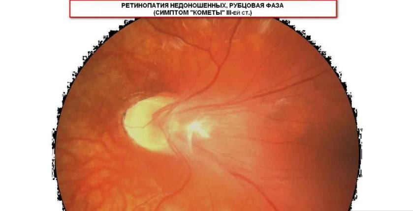 Ретинопатия недоношенных - симптомы болезни, профилактика и лечение ретинопатии недоношенных, причины заболевания и его диагностика на eurolab