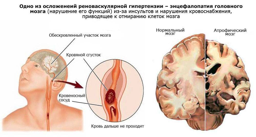 Резидуальная энцефалопатия головного мозга, энцефалопатия у детей
