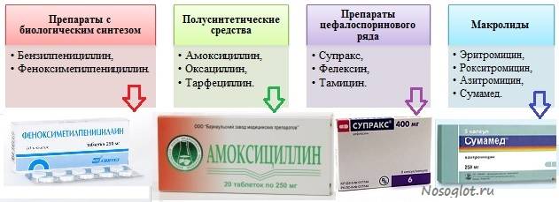 Ангина