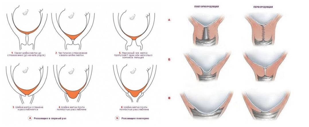 Шейка матки после. Раскрытие маточного зева. Открытие шейки матки при родах. Раскрытие маточного зева при родах. Раскрытие наружного зева.
