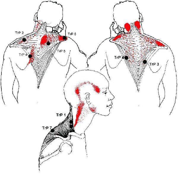 Боль в шее (шейном отделе) лечение, причины, симптомы, защемление нерва клинка в москве