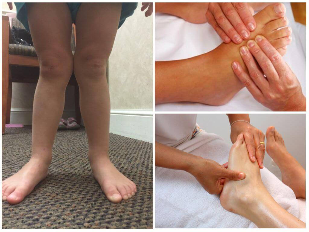 Косточка на ноге (вальгусная деформация): лечение халюс вальгус - напоправку – напоправку