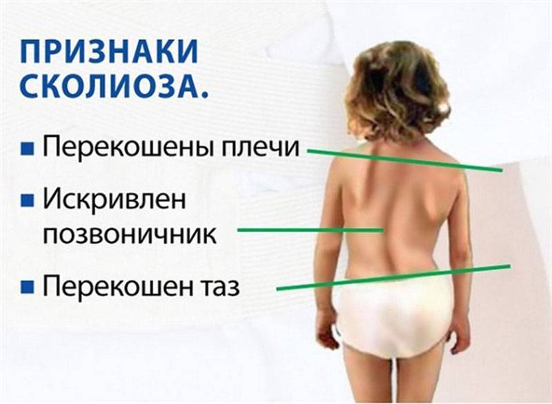 Можно ли при сколиозе заниматься спортом - ортопедия