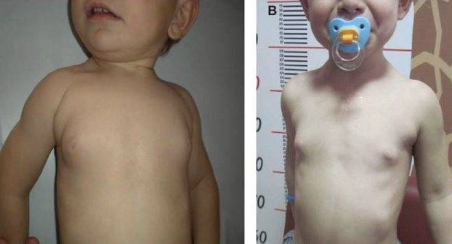 Изолированное телархе дев. 6 лет - вопрос детскому эндокринологу - 03 онлайн