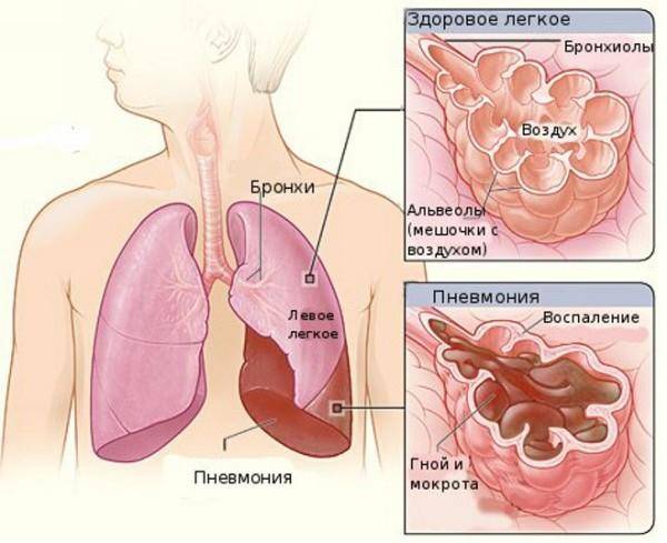 Микоплазменная пневмония | eurolab | пульмонология