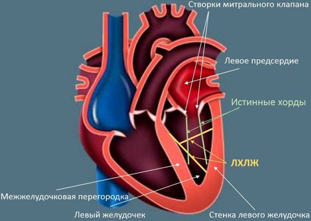 Дополнительная хорда левого желудочка сердца у ребенка: что это такое, причины, что делать