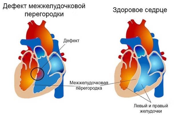 Мрт и кт детям. кт и мрт диагностика дефекта межжелудочковой перегородки сердца у детей