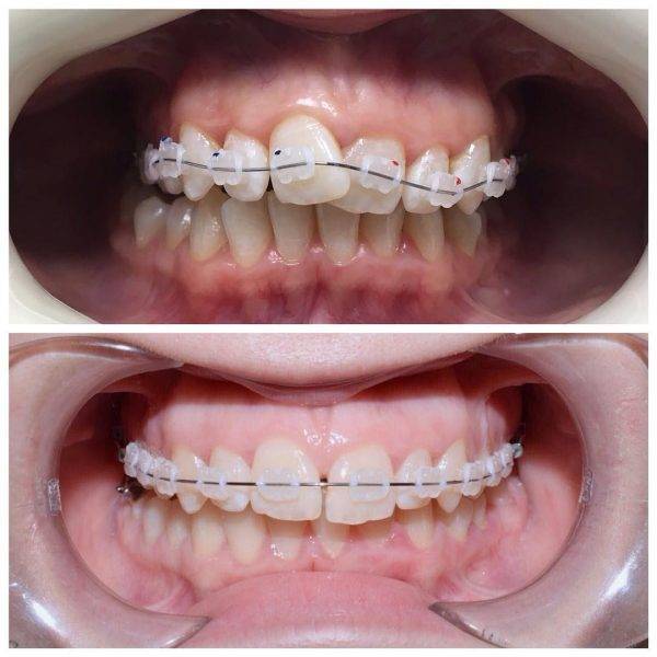 Установка брекетов на зубы, сколько стоит лечение зубов брекет-системой в москве (цены и виды брекетов)