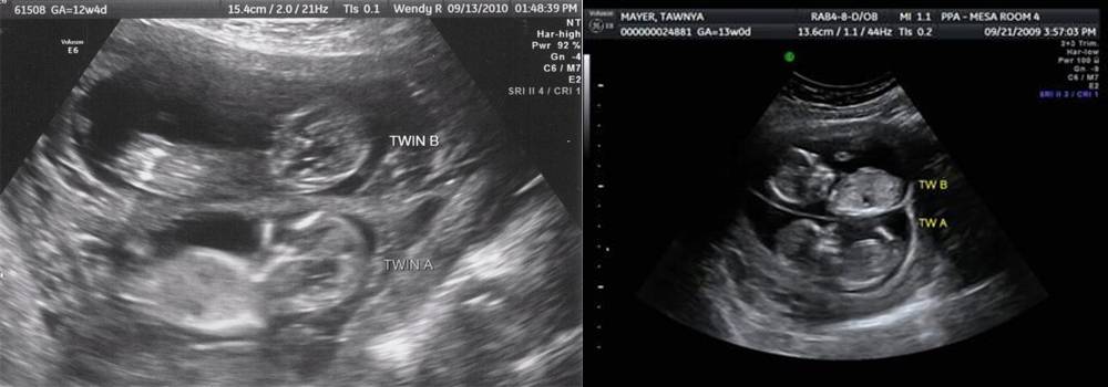 На каком сроке беременности можно определить двойню или близнецов