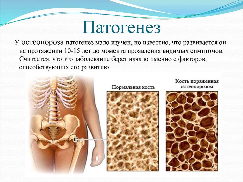 Мраморная болезнь - симптомы болезни, профилактика и лечение мраморной болезни, причины заболевания и его диагностика на eurolab