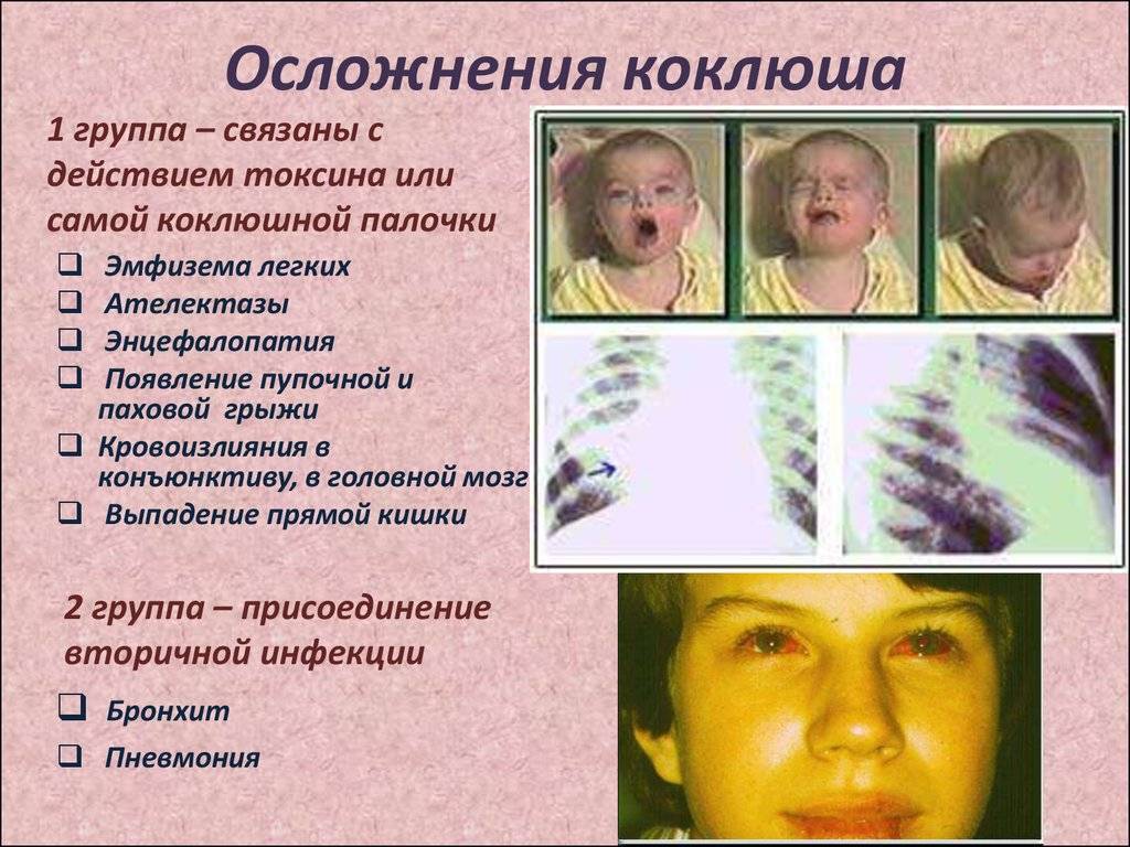 Лечение стоматита у детей