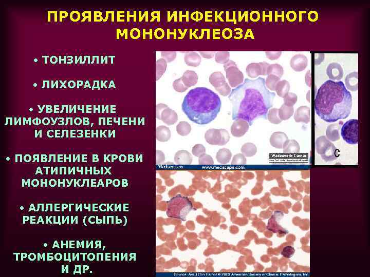 Цитомегаловирус, днк cmv в крови