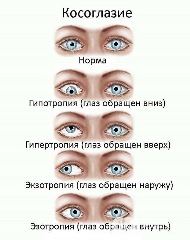 Упражнения для глаз при косоглазии - энциклопедия ochkov.net