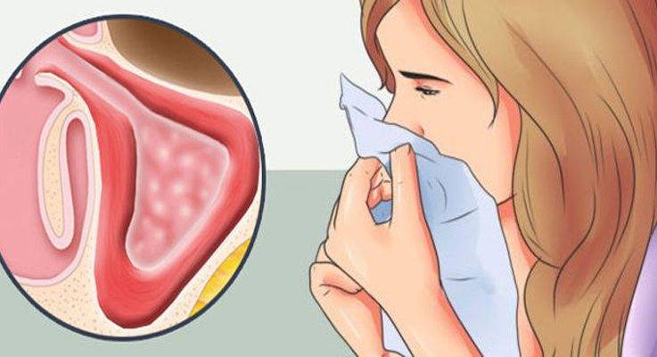 Чем лечить насморк и першение в горле без температуры