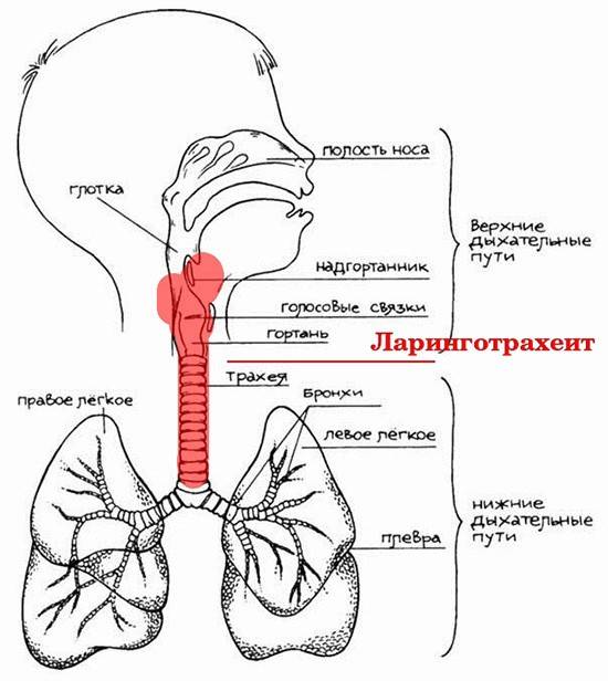 Ларингит трахеит. Стенозирующий ларинготрахеит ложный. Стенозирующий ларинготрахеит ложный круп что это. Раздражение дыхательных путей. Ларинготрахеит этиология.